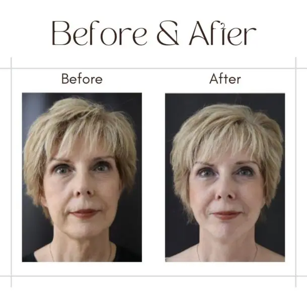 facelift Surgery Before after