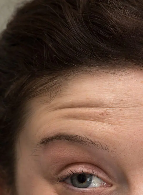 Forehead Lines