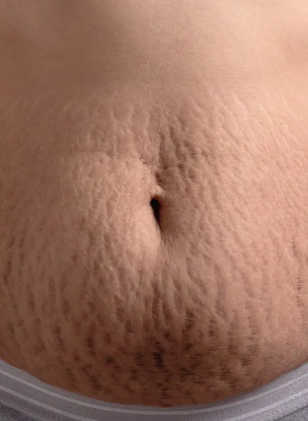 Stretch Marks