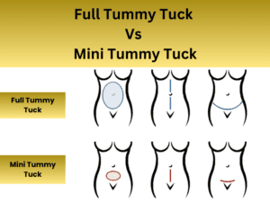 difference between tummy tuck and mini tummy tuck