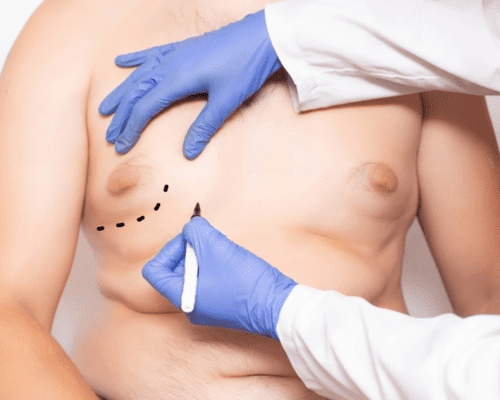 What is Gynecomastia