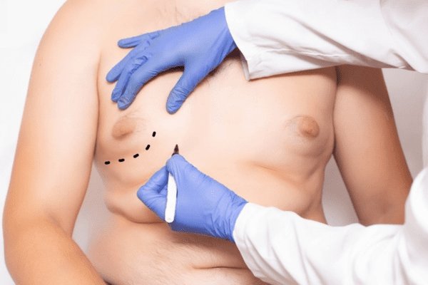 What is Gynecomastia