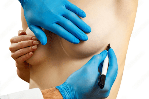 breast lift recovery