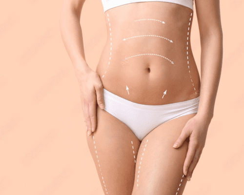 tummy tuck results