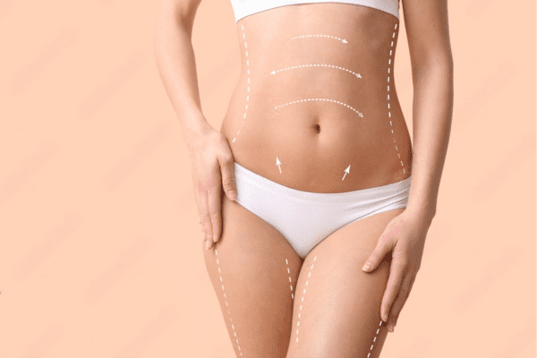 tummy tuck results