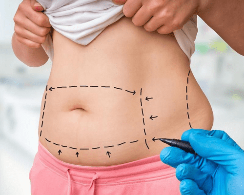 Tummy Tuck Surgery