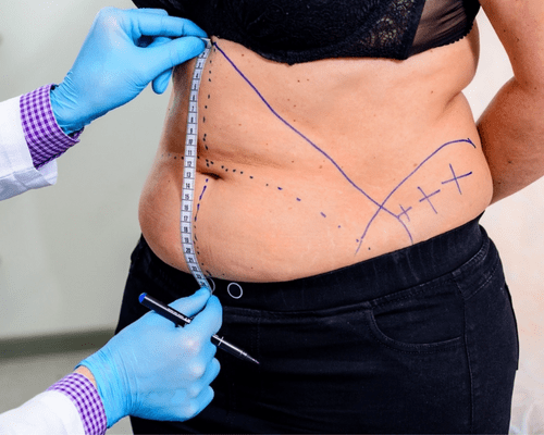 Tummy Tuck Surgery