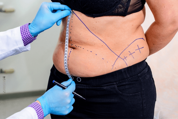 Tummy Tuck Surgery