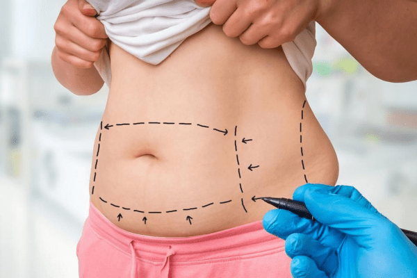 Tummy Tuck Surgery