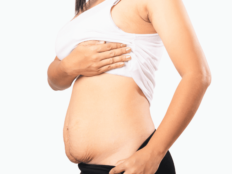 tummy tuck after pregnancy