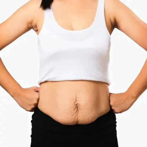 Liposuction vs. Tummy Tuck