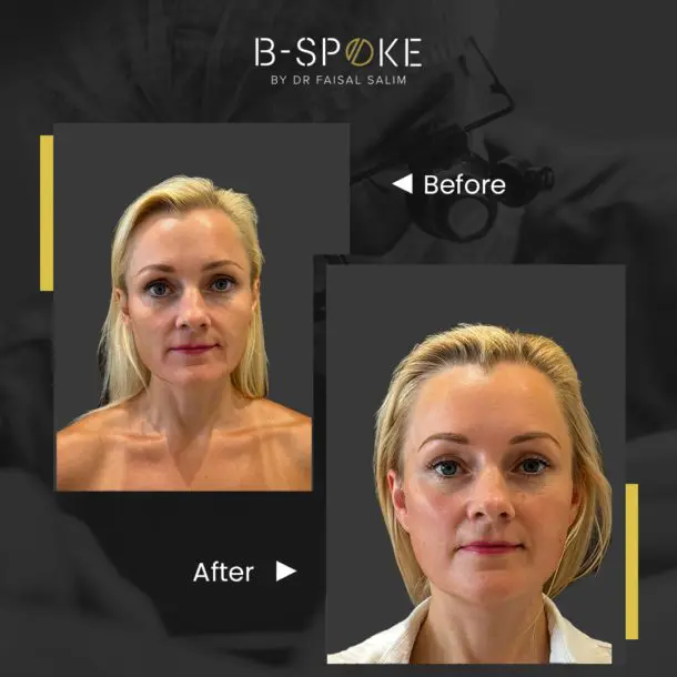 Before after image of Facelift