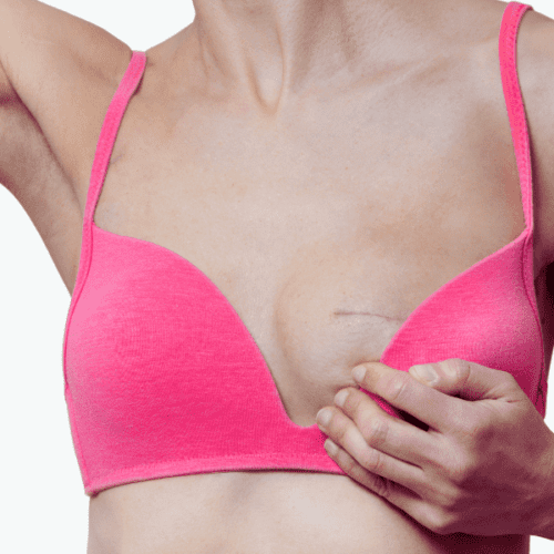 How to Minimize Breast Augmentation Scars