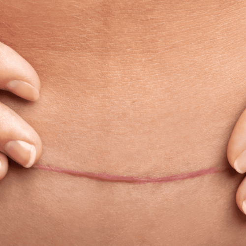 Types of Breast Lift Scars