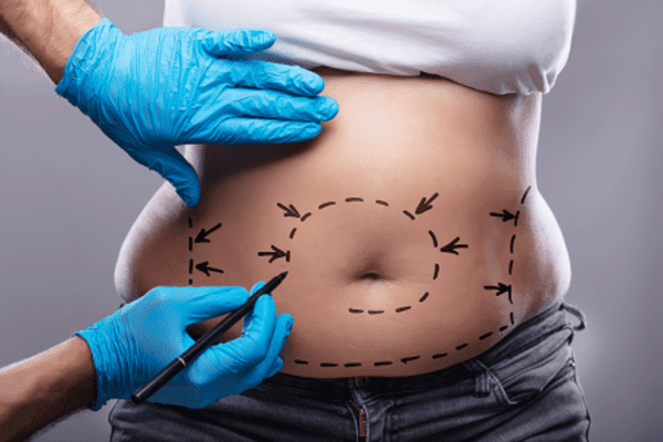 Abdominoplasty / Lipoabdominoplasty tummy tuck