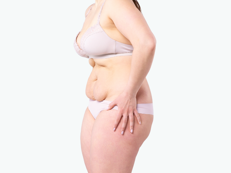 Tummy Tuck After Pregnancy