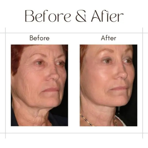 facelift before after