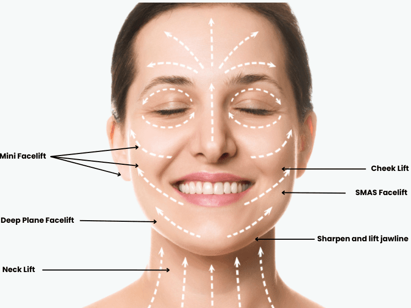 types of facelift surgery