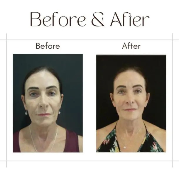 facelift before after image -4