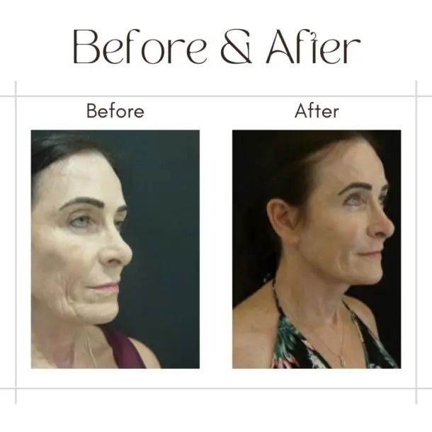 facelift before after image -2