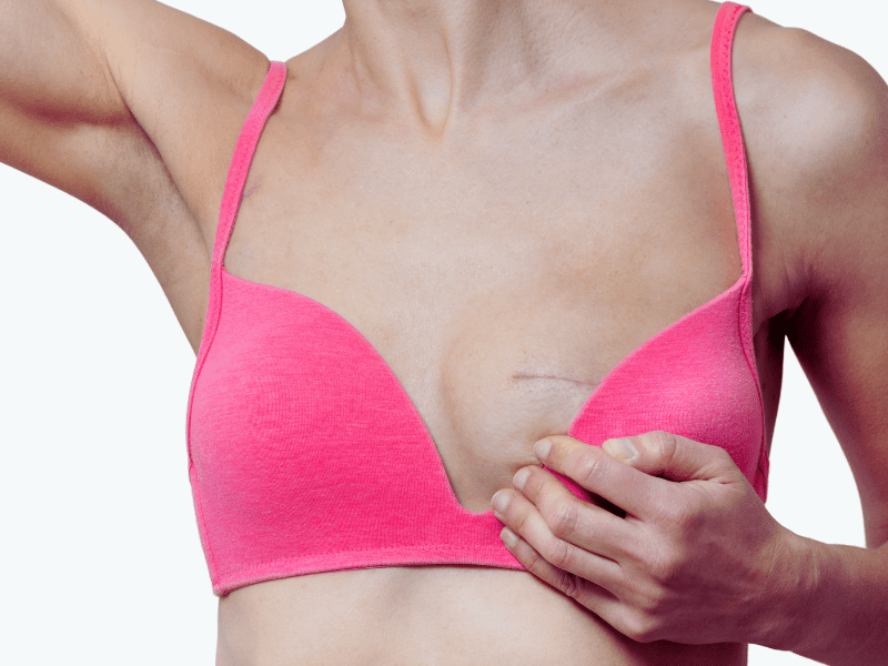 How to Minimize Breast Augmentation Scars