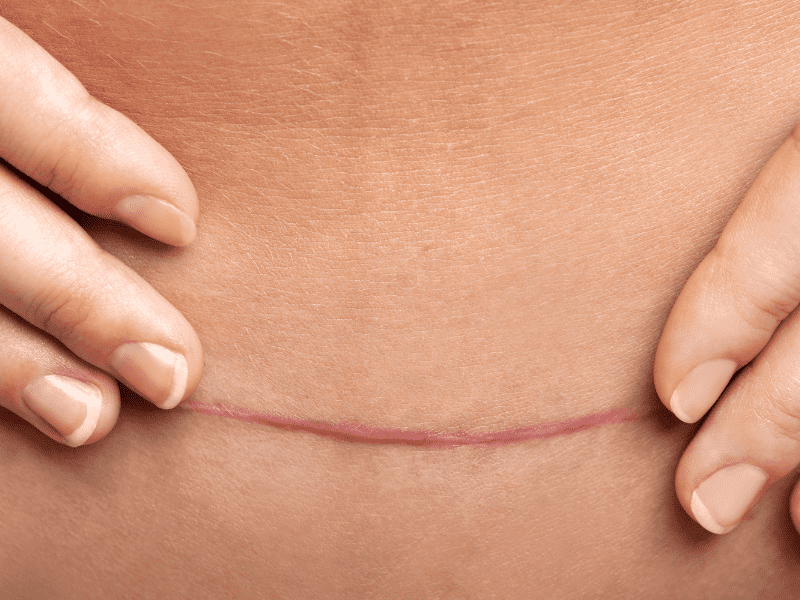 Types of Breast Lift Scars